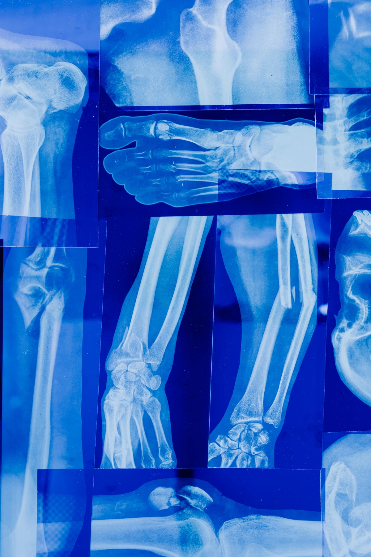 Osteoporosis Isn’t Just About Calcium: Why Bone Loss Still Happens – Dr ...